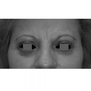 blefaroplastie-inferioara-caz-1-dupa-operatie-vedere-frontala-rezultat-la-5-ani-1