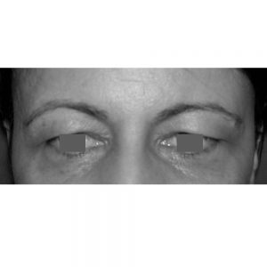 blefaroplastie-superioara-caz-3-inainte-de-operatie-vedere-frontala