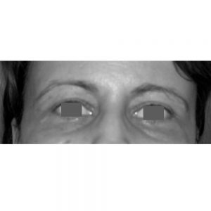 blefaroplastie-superioara-caz-3-vedere-frontala-dupa-operatie